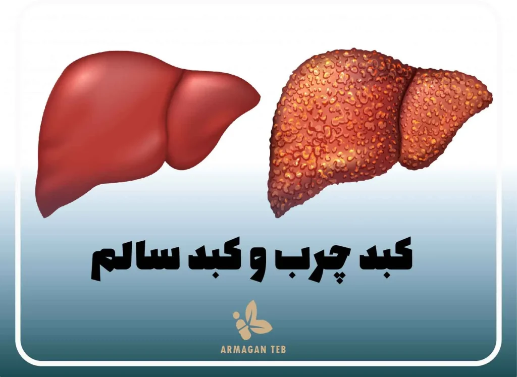 علت های مبتلا شدن به کبد چرب چیست ؟