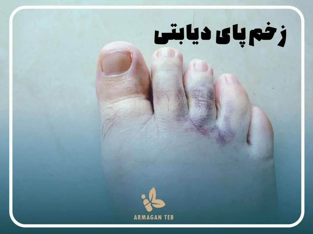 چرا زخم پای دیابتی ایجاد می شود؟