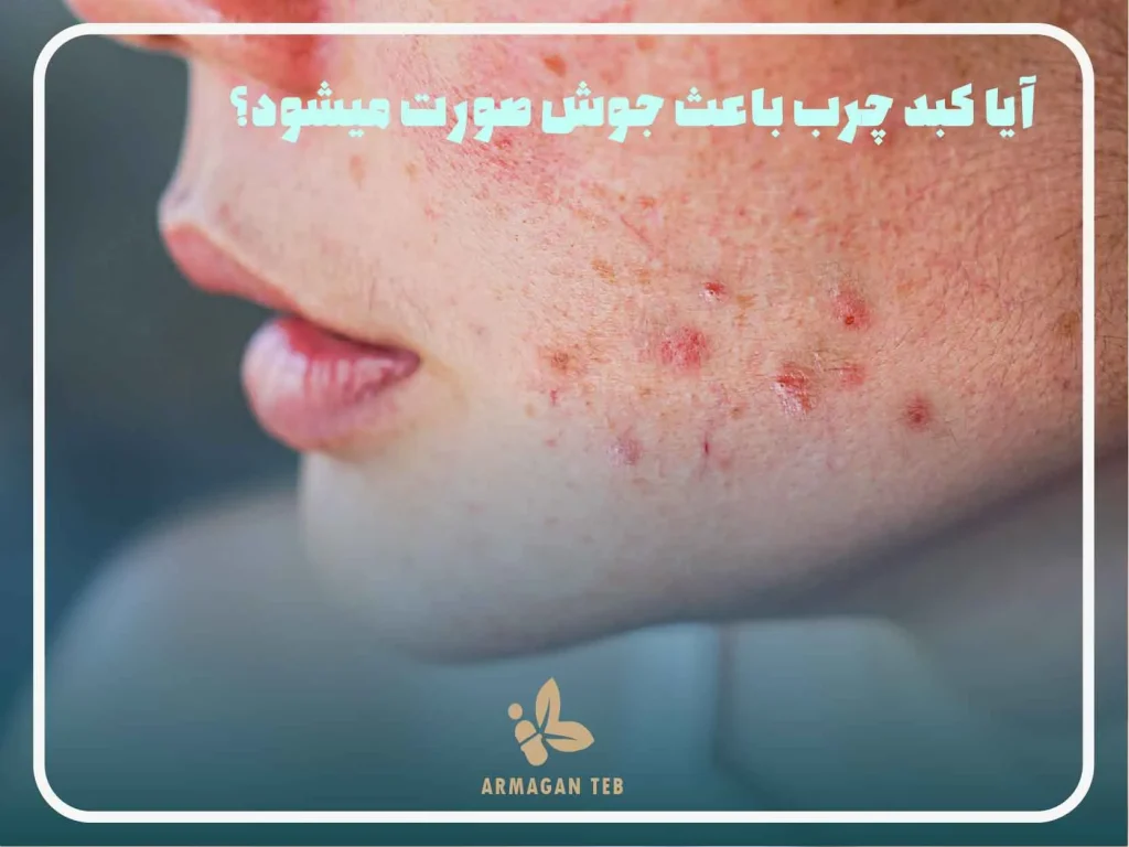 آیا کبد چرب باعث جوش صورت می شود؟