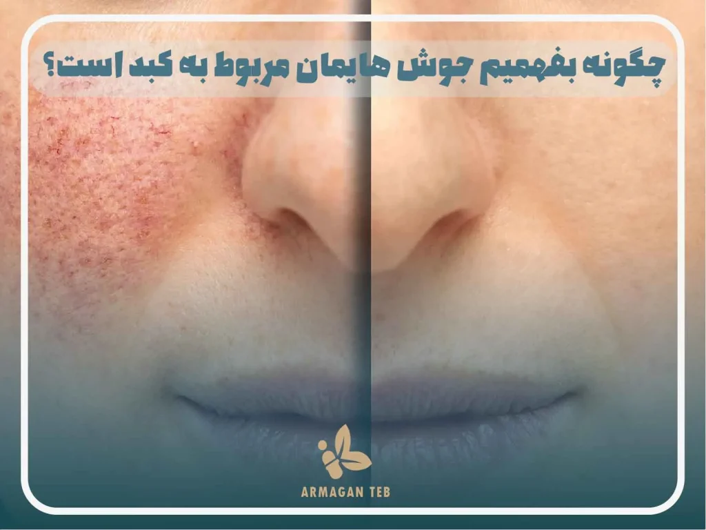 چگونه بفهمیم جوش هایمان مربوط به کبد است؟​
